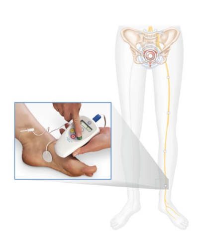 Illustration of PTNS treatment process | University of Colorado Urogynecology