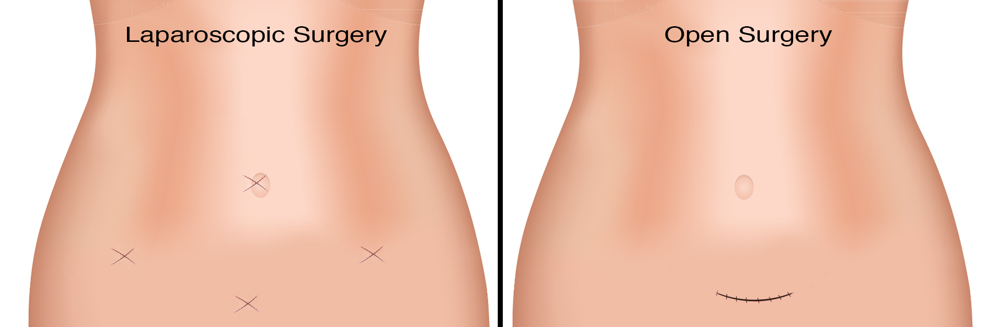 Comparison of laparoscopic and open scar placement for female pelvic surgery | University of Colorado Urogynecology | Denver, CO